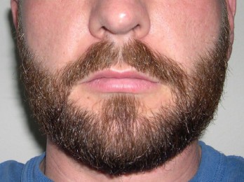 Рекомендации по применению мази для роста бороды