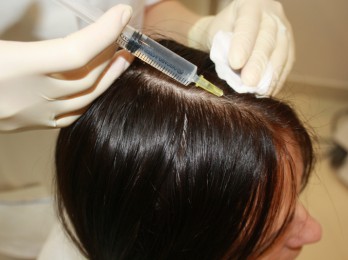 Особенности процедуры мезотерапии для волос